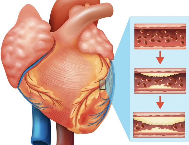 Những biểu hiện của bệnh mạch vành dễ nhầm lẫn