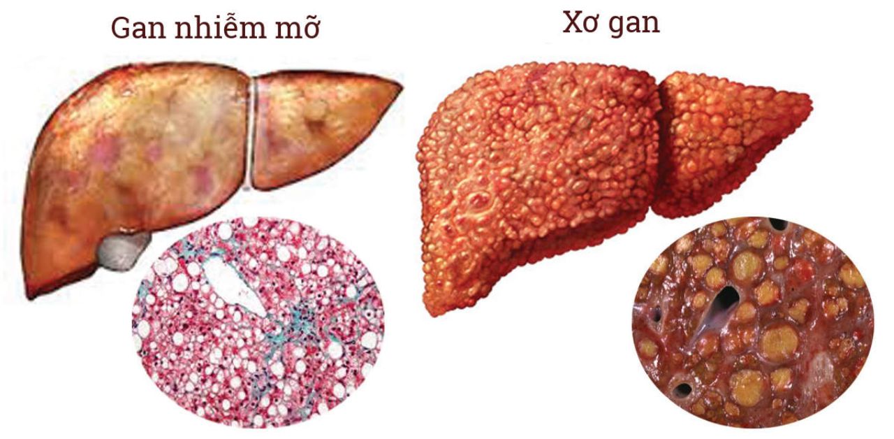 Những biểu hiện của xơ gan bạn cần biết