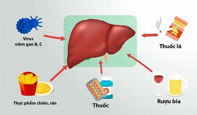 Những biểu hiện men gan cao nam giới tuyệt đối đừng chủ quan