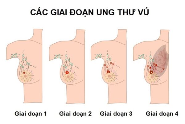 Những biểu hiện ung thư vú không nên chủ quan