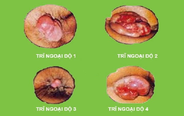 Những cách chữa bệnh trĩ hiệu quả bạn cần biết