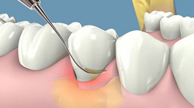 Những cách tẩy cao răng tự nhiên