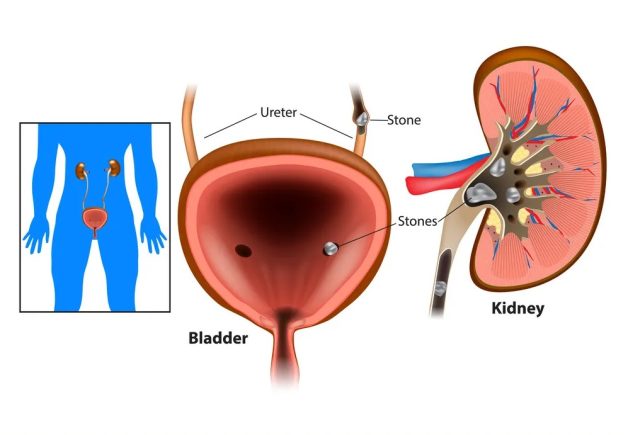 Những cách xử lý sỏi bàng quang hiệu quả và an toàn