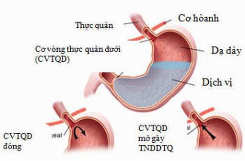 Những con số đáng kinh ngạc về bệnh trào ngược dạ dày