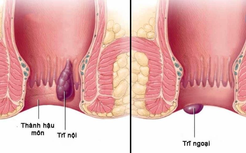 Những đặc điểm cần biết về trĩ bệnh học 