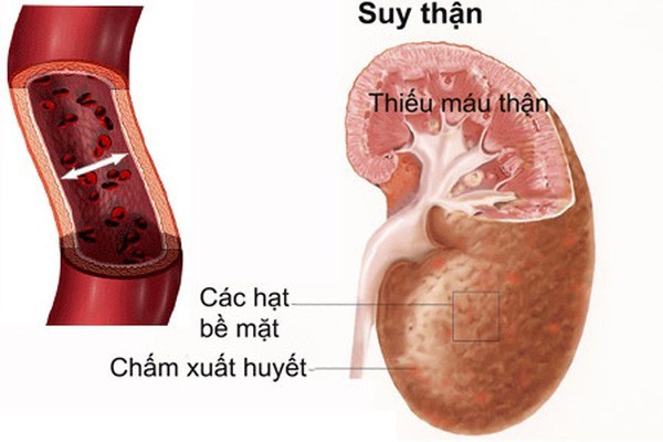 Những dấu hiệu cảnh báo bệnh thận