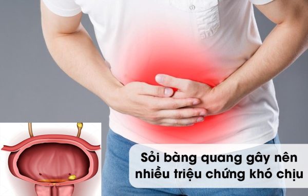 Những dấu hiệu “cảnh báo” căn bệnh sỏi bàng quang