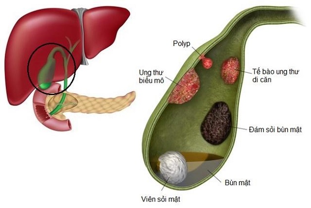 Những dấu hiệu “chỉ điểm” bệnh ung thư mật