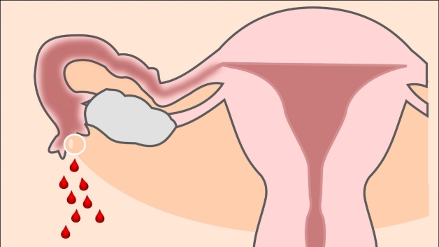 Những dấu hiệu chửa ngoài tử cung là gì?