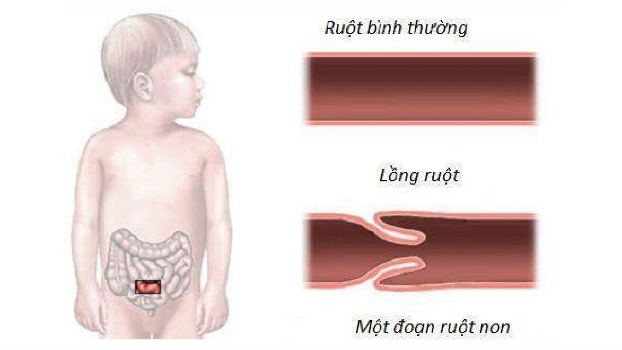 Những dấu hiệu trẻ bị lồng ruột cha mẹ cần phải biết