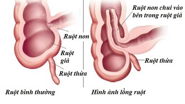 Những dấu hiệu trẻ bị lồng ruột cha mẹ cần phải biết