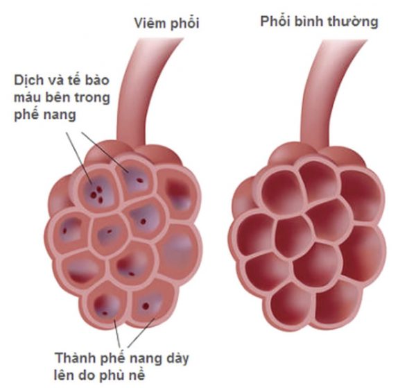 Những dấu hiệu trẻ bị viêm phổi ba mẹ cần đặc biệt lưu ý?