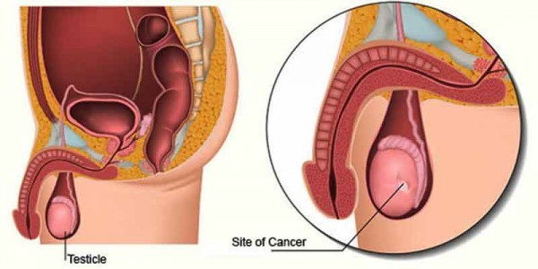 Những dấu hiệu ung thư tinh hoàn hay gặp