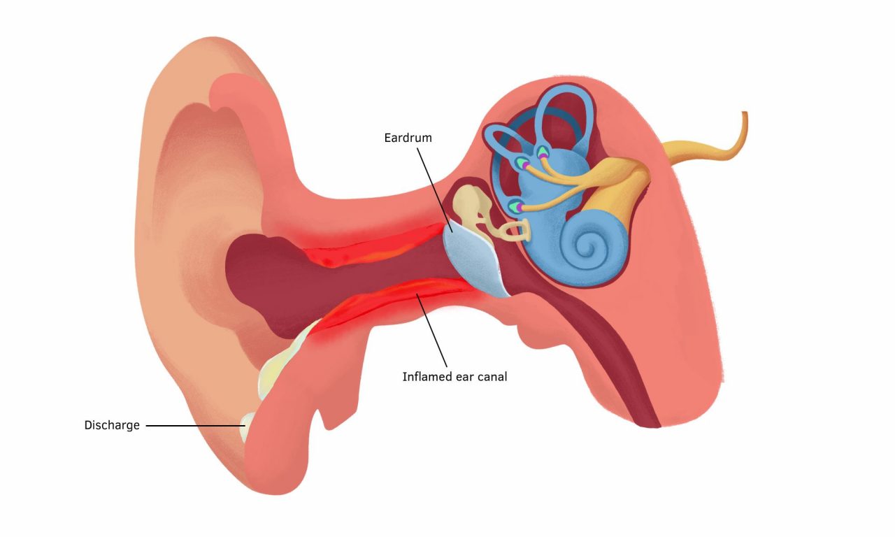 Những dấu hiệu viêm tai ngoài và điều trị thế nào hiệu quả?