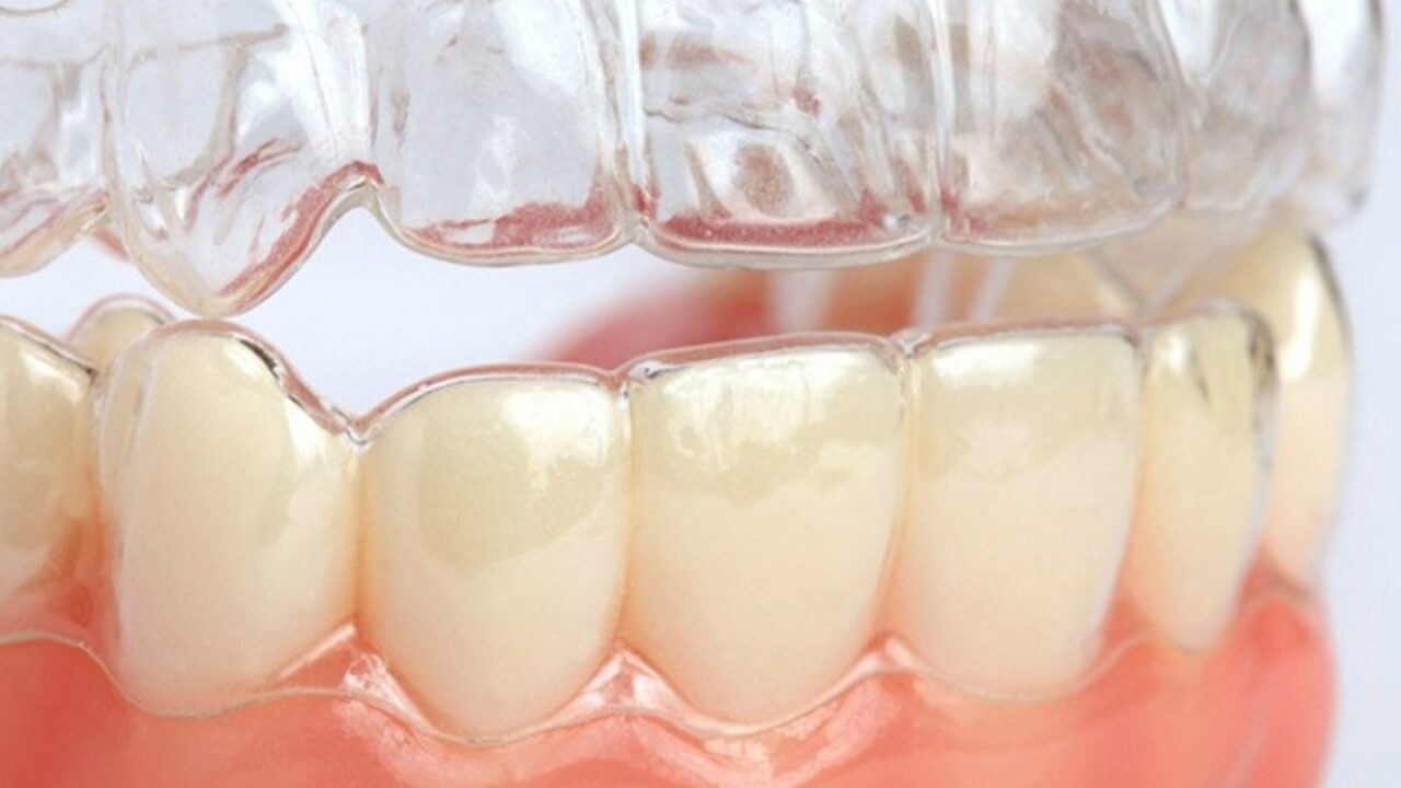 Những điểm khác nhau giữa niềng răng 3D Clear và Invisalign