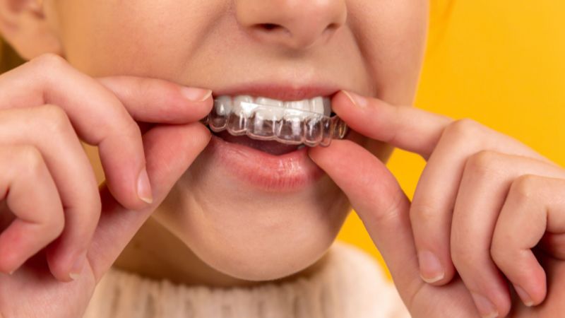 Những điểm khác nhau giữa niềng răng 3D Clear và Invisalign