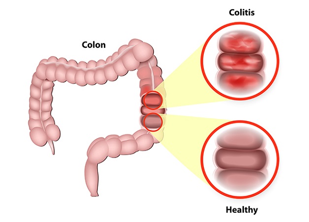 Những điều bạn cần biết khị bị đợt cấp viêm đại tràng