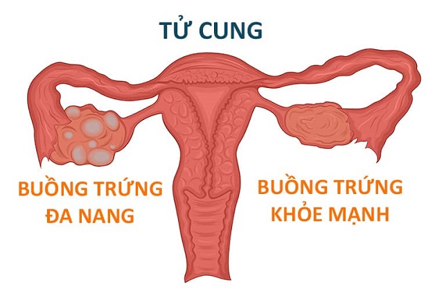 Những điều bạn cần biết về nang đa thùy buồng trứng