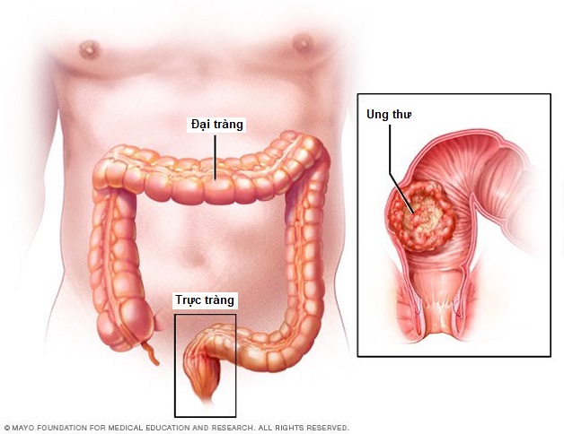 Những điều bạn cần biết về ung thư đại trực tràng