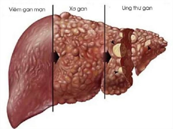 Những điều bạn có thể chưa biết về bệnh viêm gan D