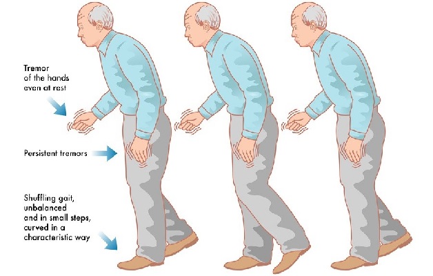 Những điều bạn nên biết về bệnh lý Parkinson