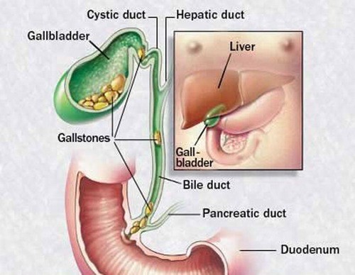 Những điều cần biết khi bị tắc nghẽn ống dẫn mật