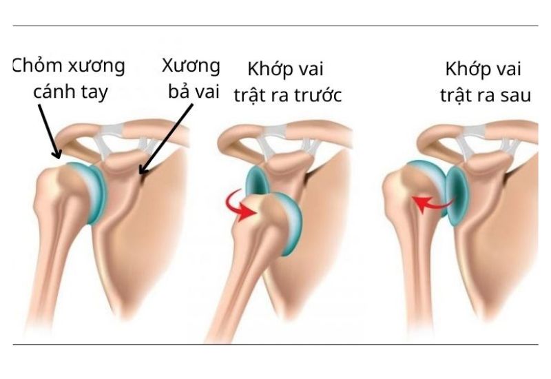 Những điều cần biết khi bị trật khớp vai