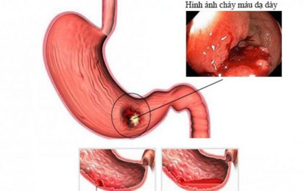 Những điều cần biết khi chảy máu dạ dày