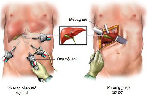 Những điều cần biết khi mổ sỏi mật