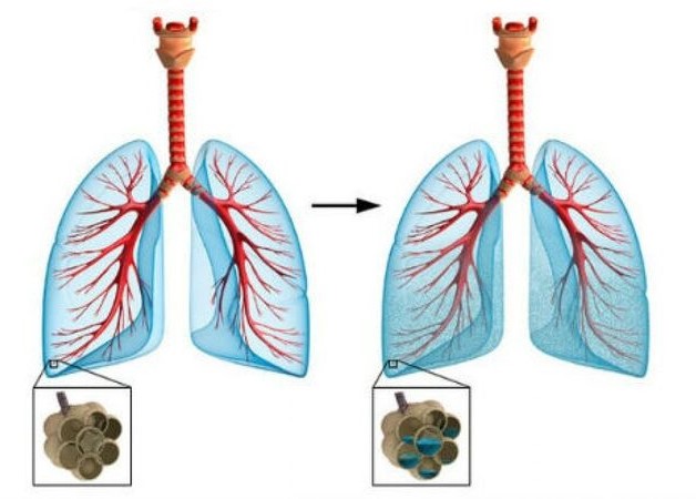 Những điều cần biết trong dự báo và điều trị suy tim cấp