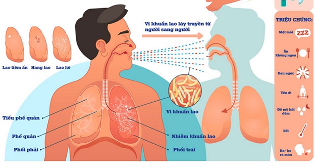 Những điều cần biết về bệnh lao