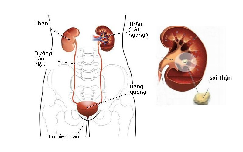 Những điều cần biết về bệnh sỏi thận