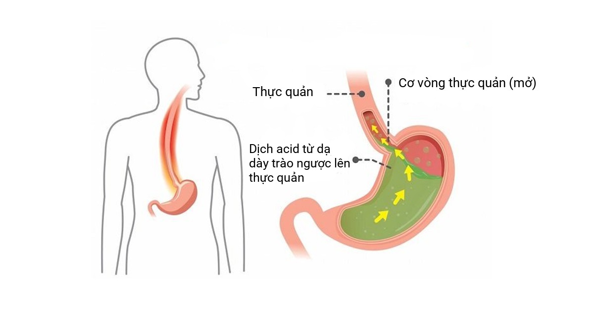 Những điều cần biết về bệnh trào ngược dạ dày thực quản