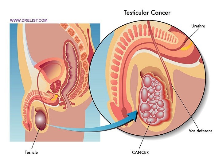 Những điều cần biết về bệnh ung thư tinh hoàn