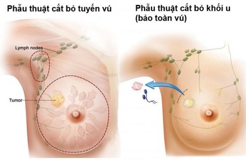 Những điều cần biết về bệnh ung thư vú và cách điều trị