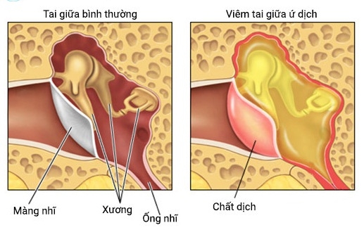 Những điều cần biết về bệnh viêm tai giữa tiết dịch ở trẻ