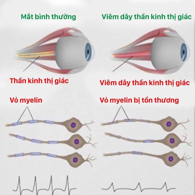 Những điều cần biết về bệnh viêm thị thần kinh cấp