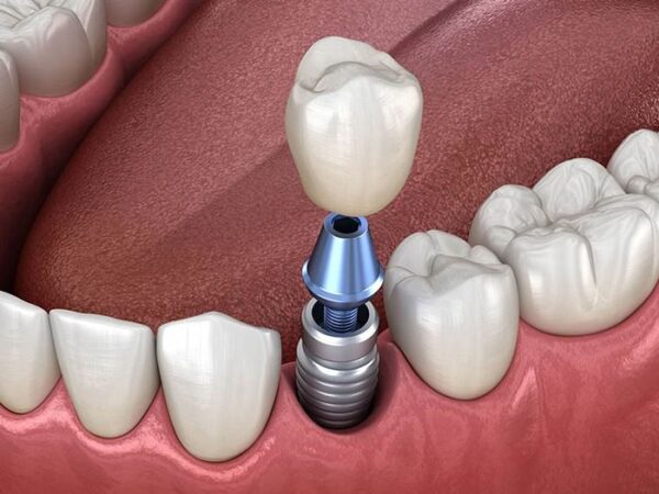 Những điều cần biết về bọc răng sứ implant