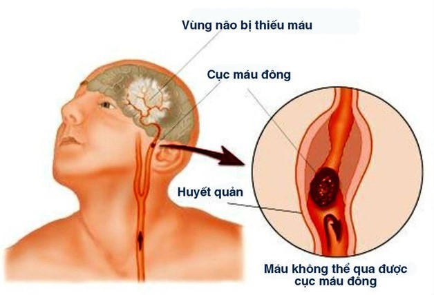 Những điều cần biết về chứng đột quỵ não cấp tính