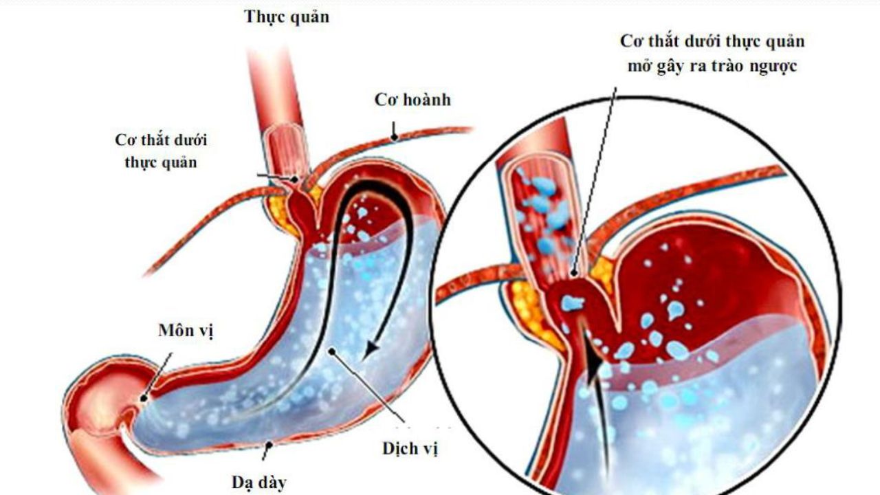 Những điều cần biết về chứng trào ngược axit dạ dày thực quản