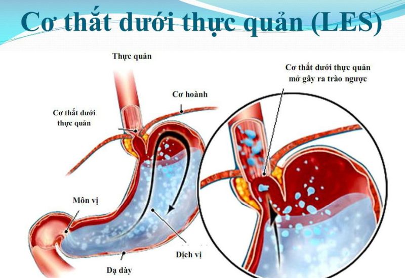 Những điều cần biết về chứng trào ngược axit dạ dày thực quản