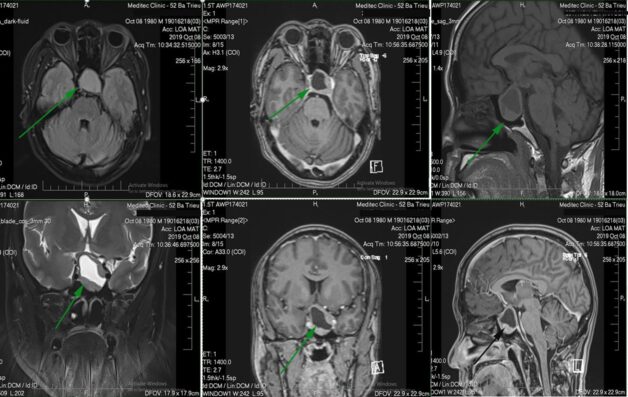 Những điều cần biết về chụp MRI tuyến yên