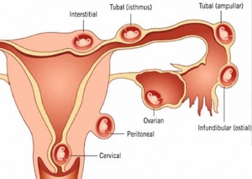 Những điều cần biết về hiện tượng thai ngoài tử cung