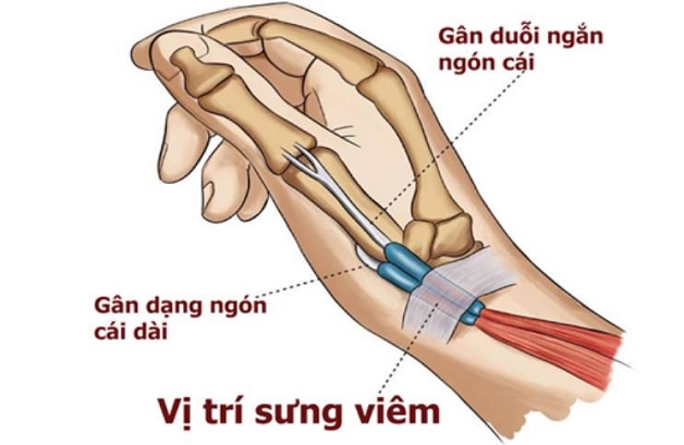 Những điều cần biết về hội chứng De Quervain