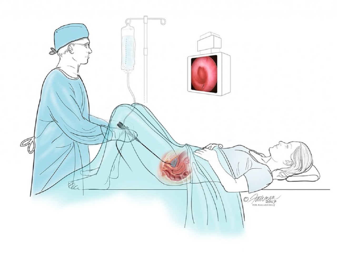 Những điều cần biết về kỹ thuật tán sỏi qua da