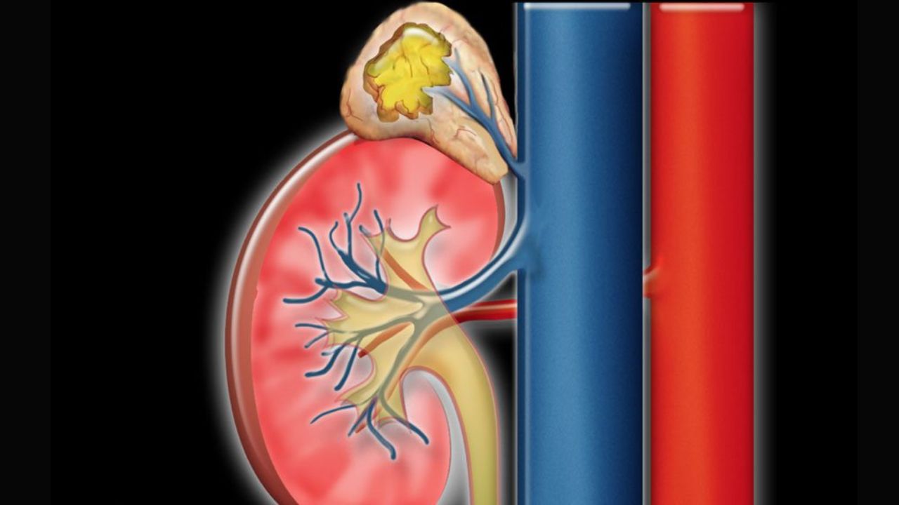 Những điều cần biết về nang tuyến thượng thận