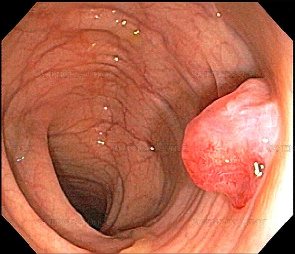 Những điều cần biết về nội soi trực tràng