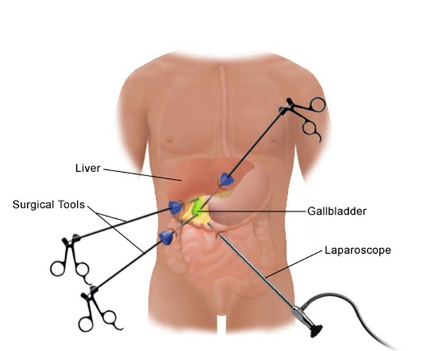 Những điều cần biết về phẫu thuật cắt túi mật nội soi