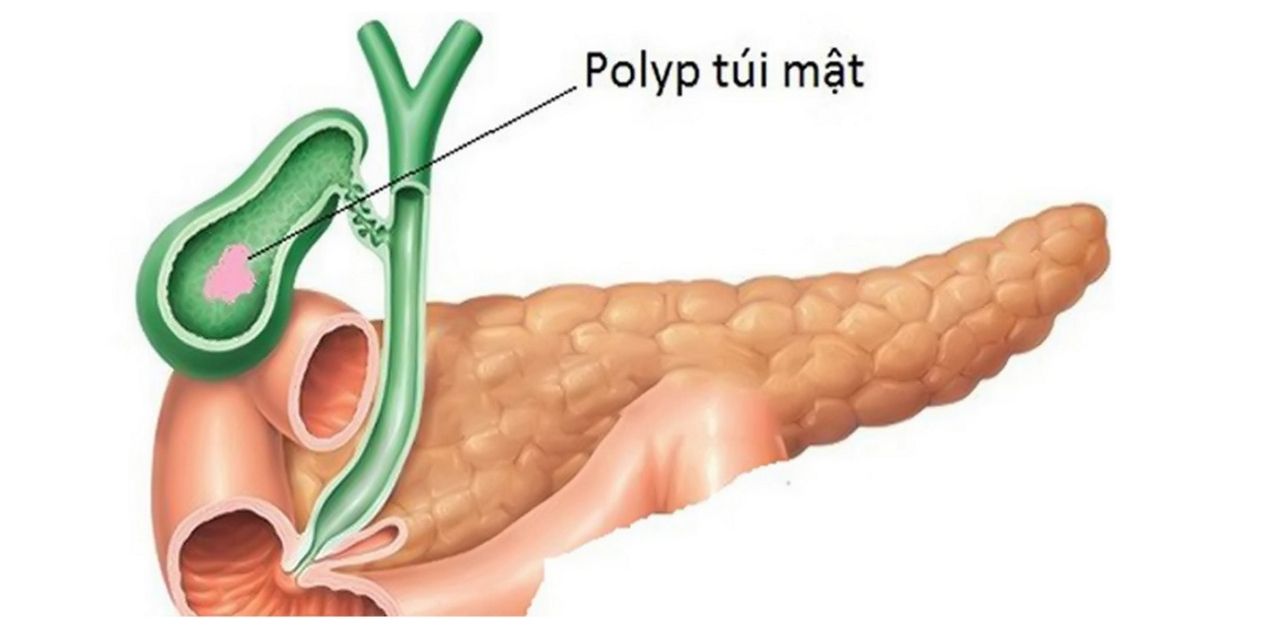 Những điều cần biết về Polyp túi mật và cách điều trị