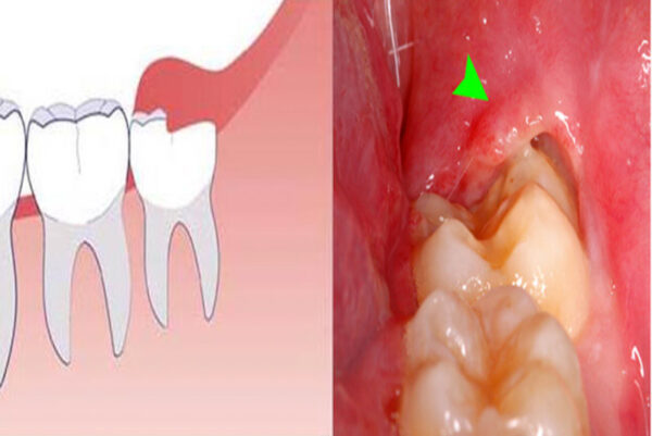 Những điều cần biết về răng số 9